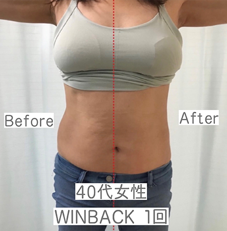 WINBACK×筋膜リリース