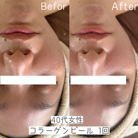コラーゲンピール