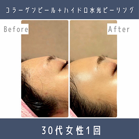 コラーゲンピール×ハイドロ水光ピーリング＆ポレーション