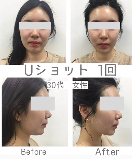 Uショット®︎（FACE）
