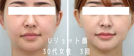 Uショット®︎（FACE）