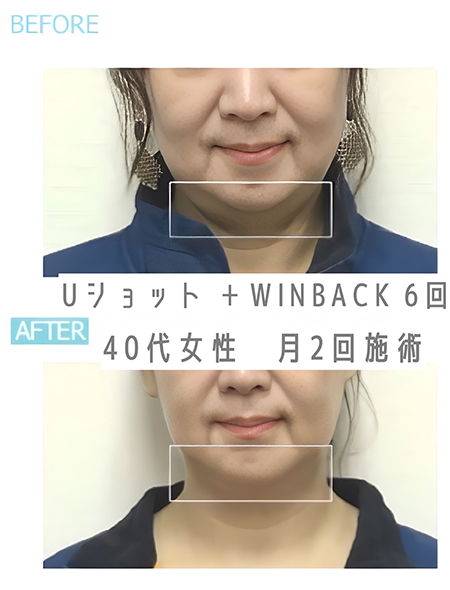 Uショット®︎×WINBACK