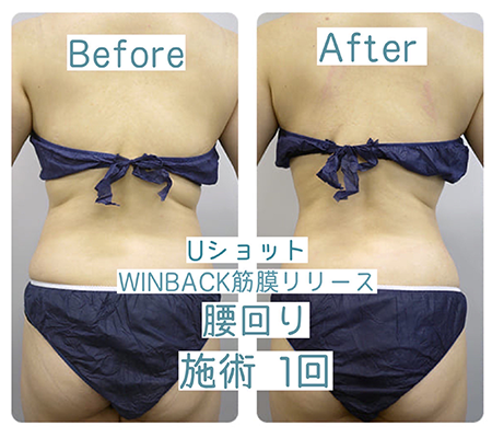 Uショット®︎×WINBACK×筋膜リリース